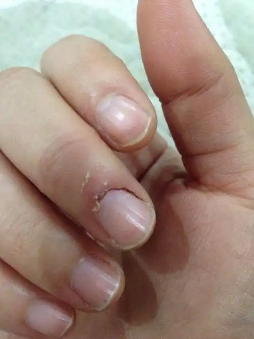 手指甲从根部裂开并流血了是什么问题