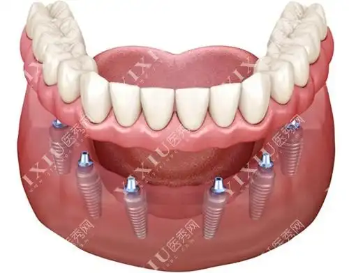 半口种植牙示意图