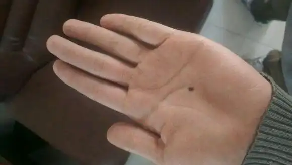 女人身体哪里长痣会有好运