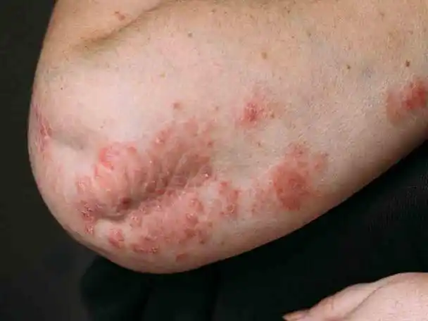 牛皮初期癣症状图片-名医汇