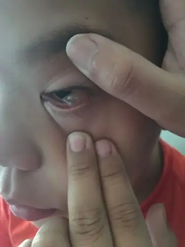 孩子眼睛里突然变成这样的了,白色透明水泡