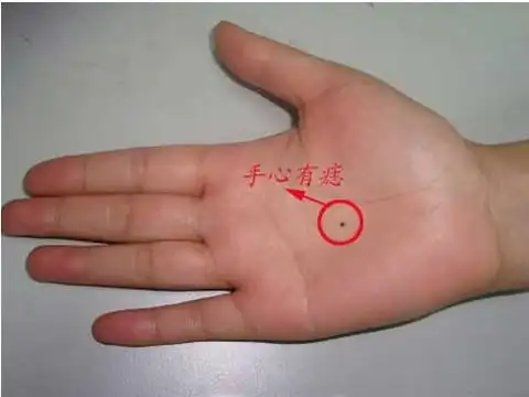 腰缠万贯痣 身体哪里长痣是富贵的象征