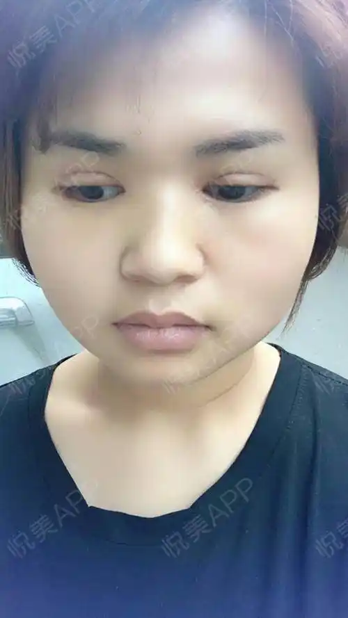 外切去眼袋术后14天_全切双眼皮术后14天_眼部多项术后14天_去眼袋术