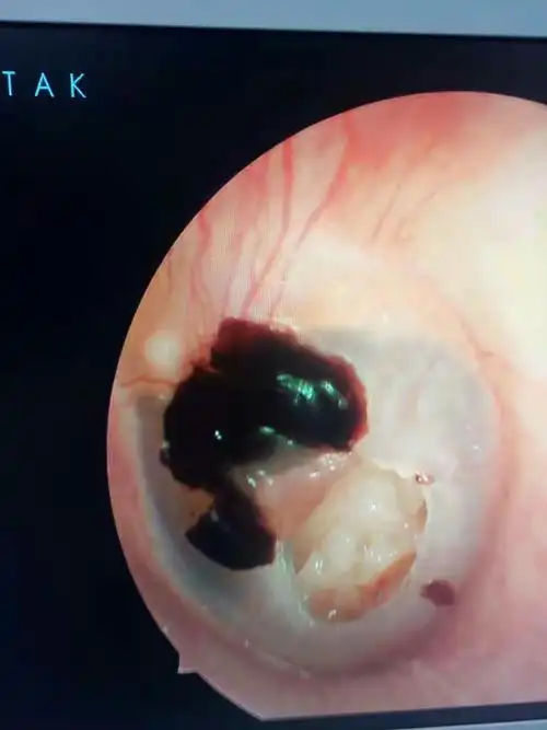 【爱耳月2】通许耳鼻喉医院神奇的鼓膜修补,让你不再"充耳不闻"