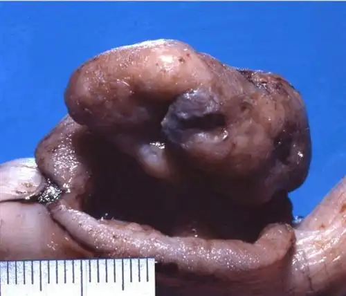 小肠平滑肌肉瘤