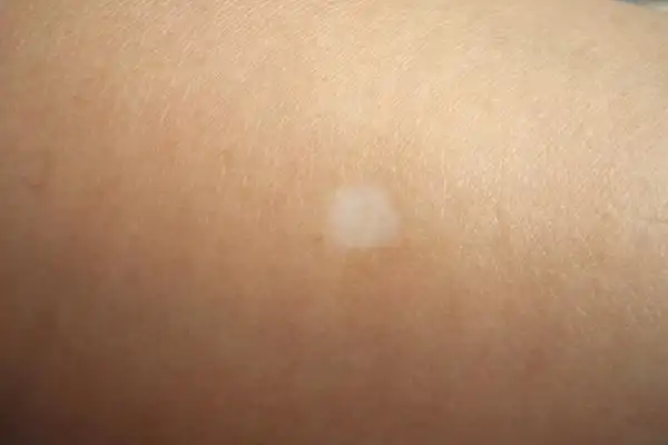 宁德白癜风初期症状图片-白癜风有什么症状 最起码是什么样子的我都不