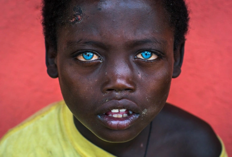 非洲男孩患罕见病症 天生蓝眼睛似混血
