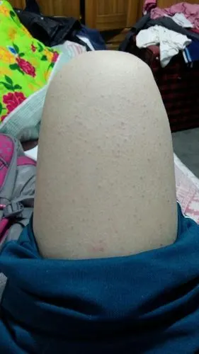 匿名| 浏览 39 次 应该是毛囊炎,用硫磺皂洗洗,在用磨皮嫩肤的产品