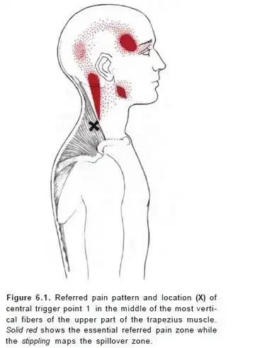 斜方肌肌筋膜综合症_疼痛_介绍_缓解方法 - 好大夫在线