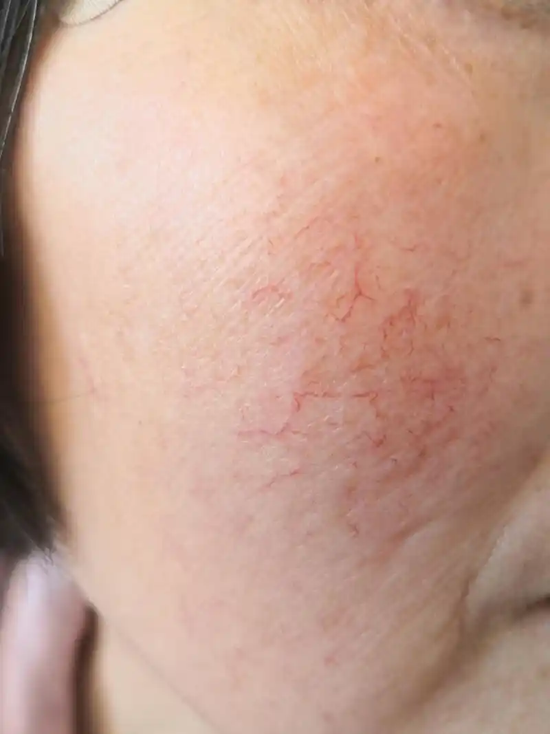 面部红血丝.#解决皮肤问题专注皮肤美容# 毛细血管扩张症.