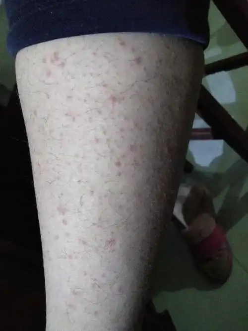 咨询医生有说过敏,有说神经性皮炎,这到底是什么啊!