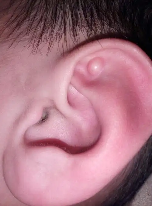 窝处一年前发现有个小米粒大小的包,去医院问了下,医生说是个假性囊肿