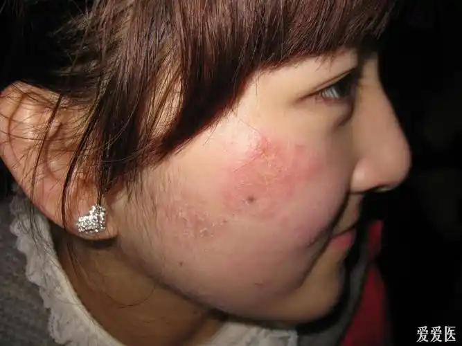 颜面部皮炎 - 皮肤及性传播疾病讨论版 - 爱爱医医学论坛