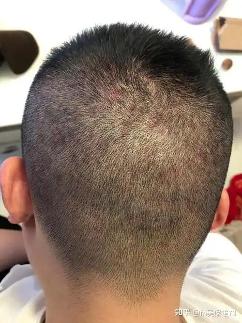 有什么可以彻底根治头皮毛囊炎的方法