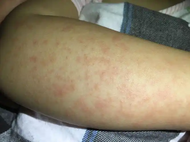 一岁三个的宝宝过敏性皮炎,胳膊上都是密密麻麻的小红点该怎么办