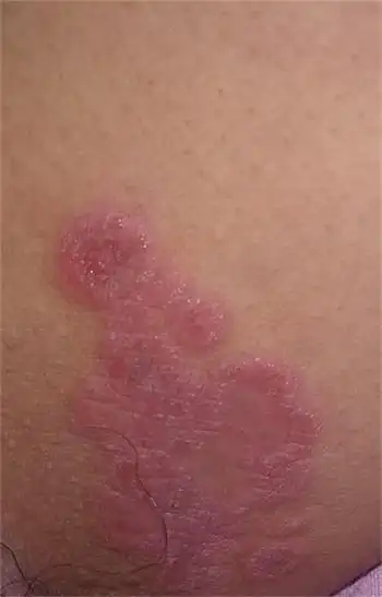 大腿内侧长股癣非常痒,越秀区哪儿可以治好股癣?