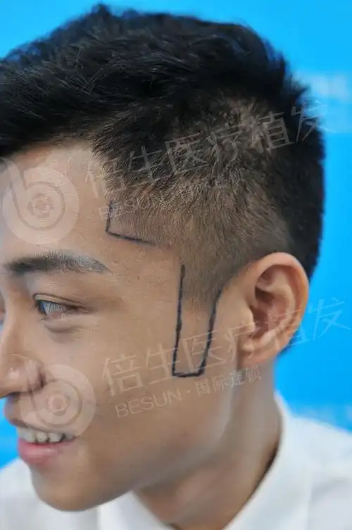 刘先生鬓角种植800单位效果展示