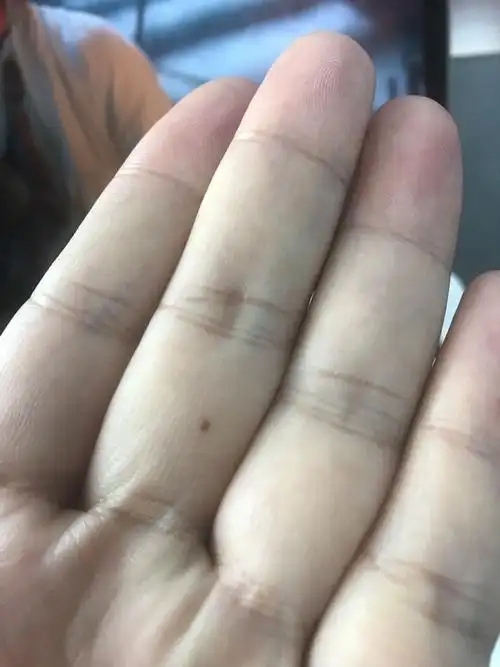 左手中指有痣,请大师出来帮分析下
