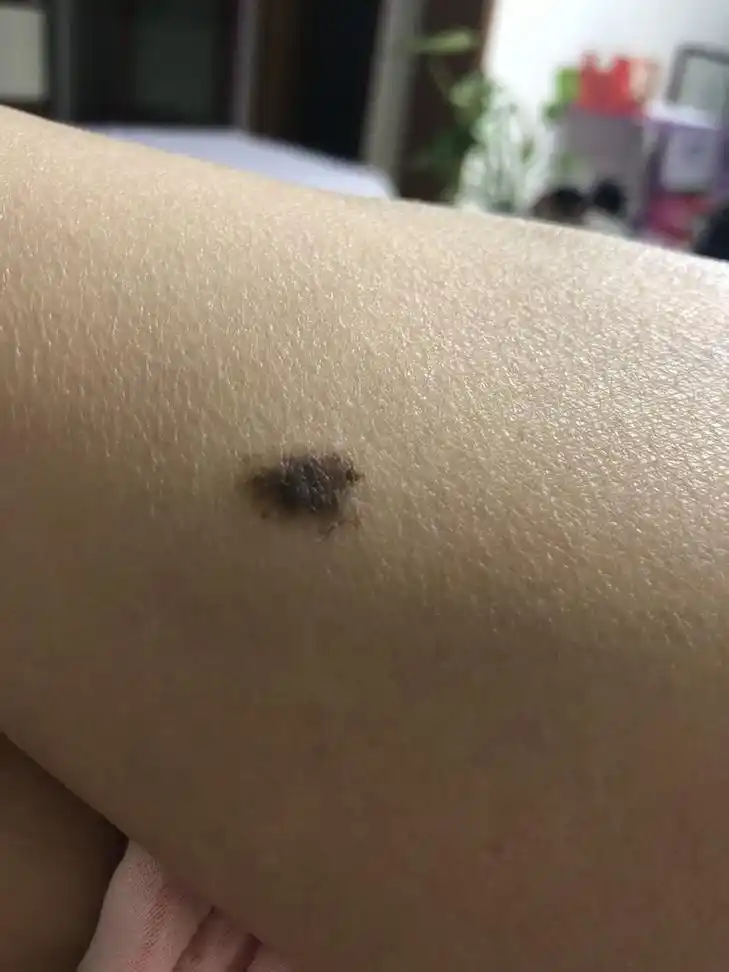 小腿内侧长有一个黑色的痣,大概有三十年了,好像没怎么长,目测有一