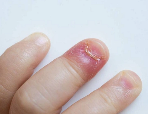 原创经常咬指甲只是坏习惯医生告诫还会引来5种疾病赶紧戒掉