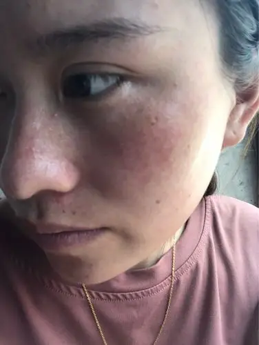 这张脸我已经不知道怎么办了……角质层薄,洗脸不敢洗,护肤品