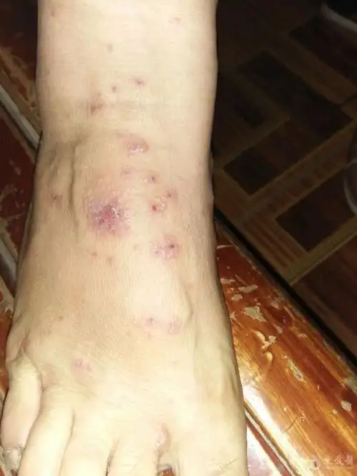 全身皮肤瘙痒十多天晚上尤甚