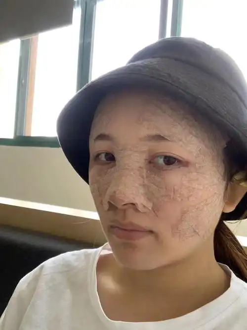 自体脂肪填充全脸第三天;刚做完那会肿胀是真的严重,现在已经好了很多