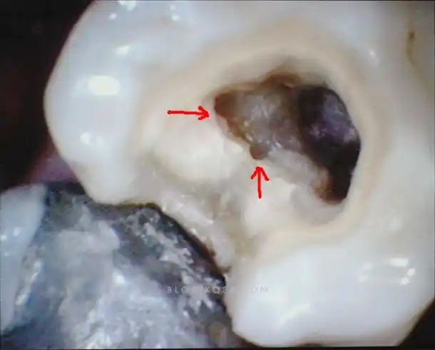 上颌6根管治疗mb2