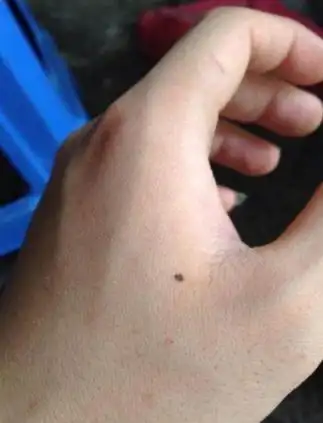 有什么含义?,虎口有痣说明什么_易安殿