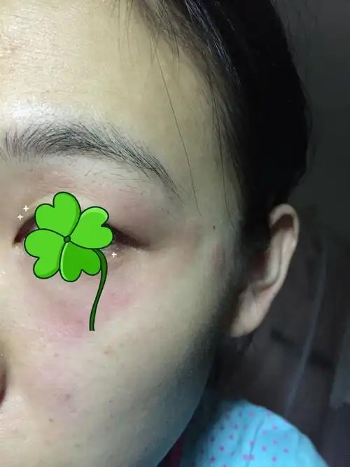 眼睛周围红红的有点痒,先很干,然后会脱皮,后面就是红红的粗糙,平时只