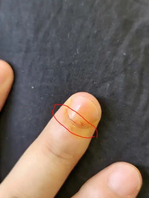 指甲根部被刀切开了会不会影响指甲生长