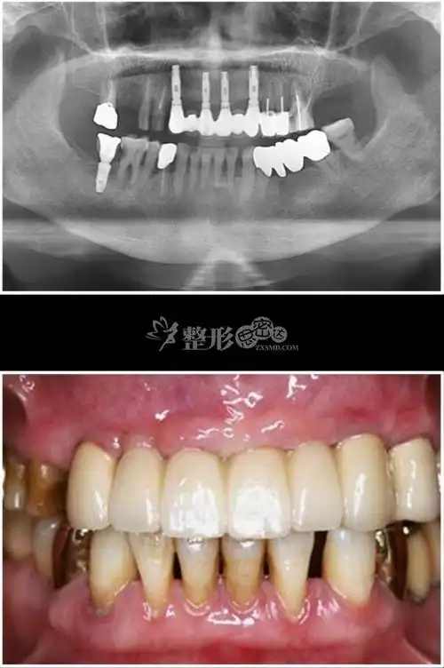 种植牙 3后.jpg