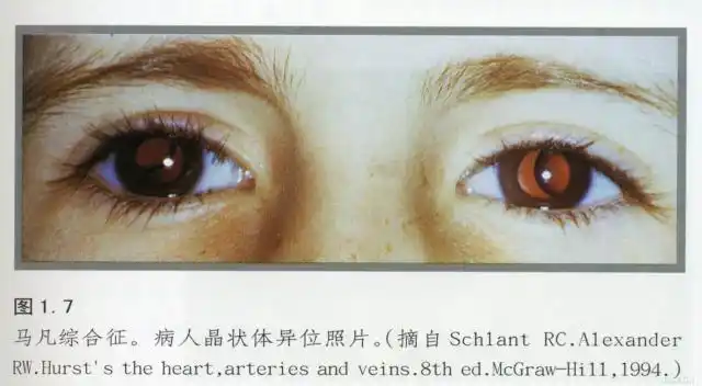 马凡氏综合征图示