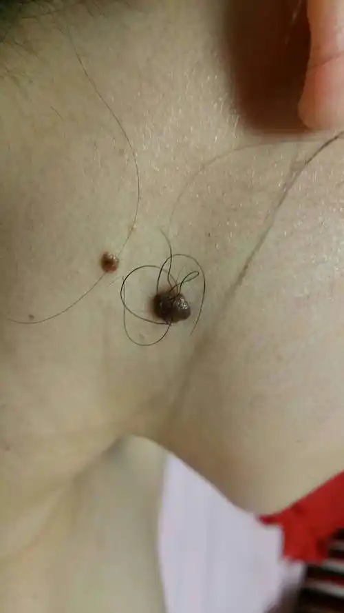 从小在右边腮帮处有两颗黑痣 一大一小 其中大的一颗一直长有毛 最近