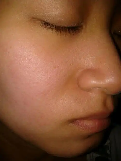 混合型敏感红血丝角质层薄的皮肤选择什么牌子的护肤品