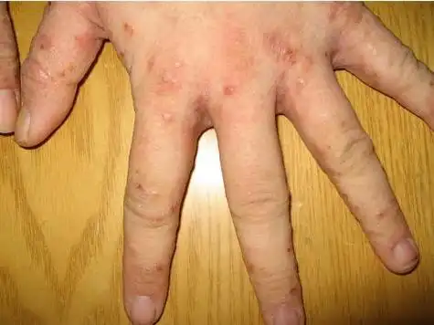 疥疮的治疗费用