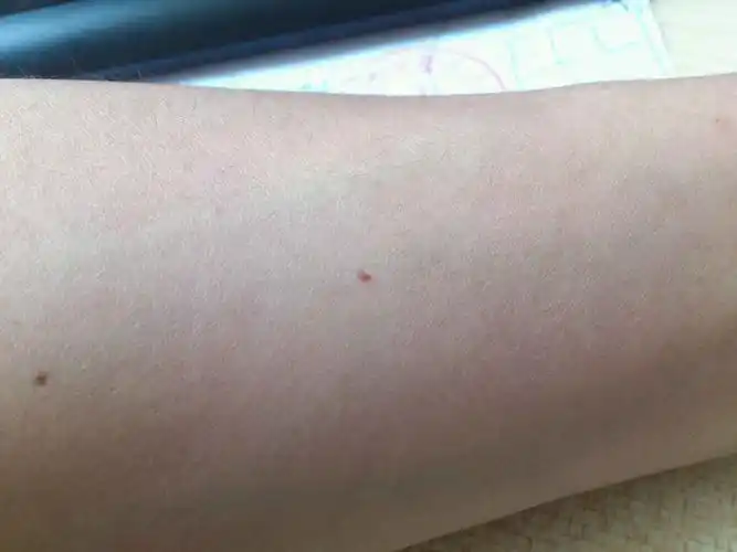 手臂上有一粒小红点,不凸起不痛不痒