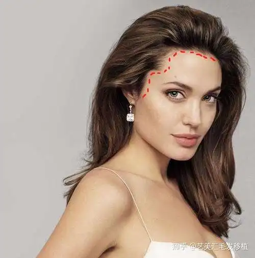 女性发际线想要植好 必须做到这几点!