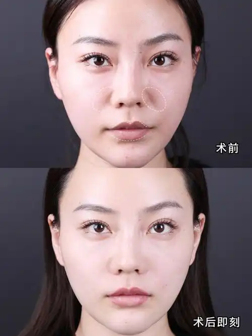 宝藏玻尿酸项目嘟嘟唇,轻松驾驭纯欲辣妹风