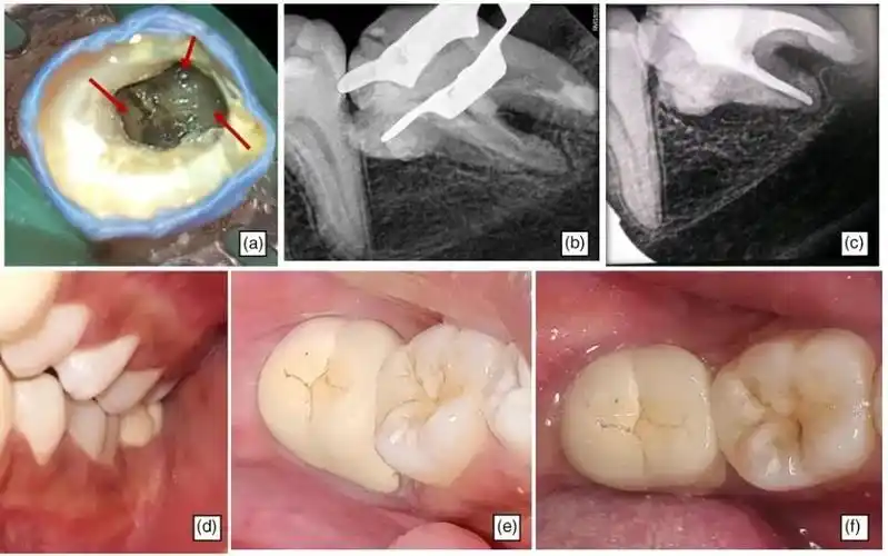 【病例报告】下颌第二磨牙融合牙瘤的牙髓处理 -- 江苏省口腔医院