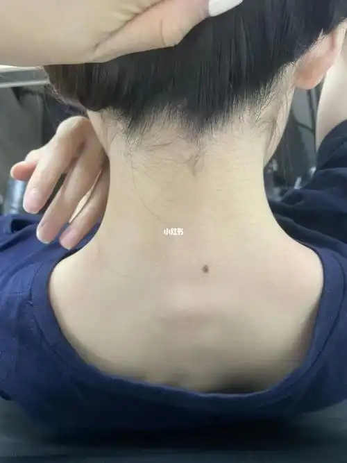 我背上有痣好吗