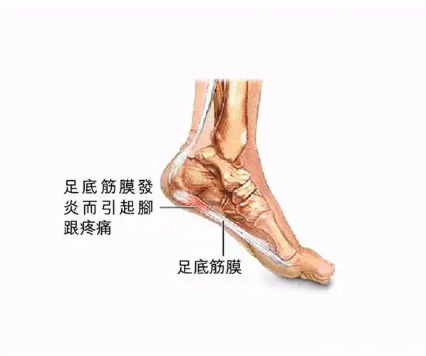 中老年人出现脚底板疼,常有3种病因,医生告诉您如何鉴别及治疗