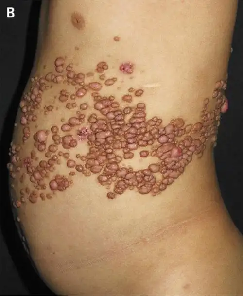 过目难忘:节段性神经纤维瘤病