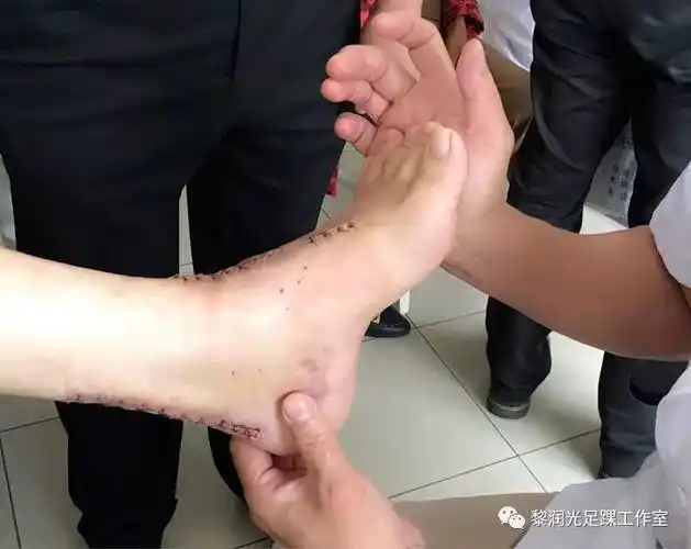 自行降解,缝线自行脱落,不需要拆线,但是抗张力差,以及存在吸收线反应