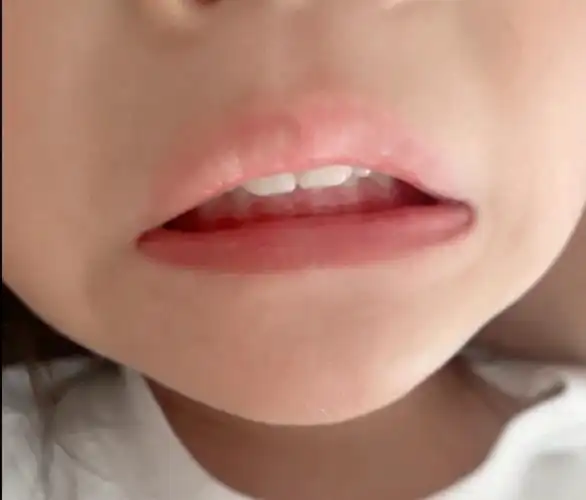 包下牙请注意 br>最近几个月发现姐姐的上牙骨越来越高,牙齿包住下牙
