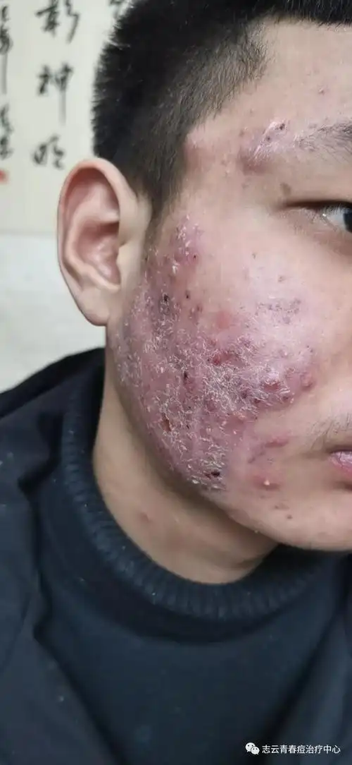 怎么治疗红肿的痘痘?