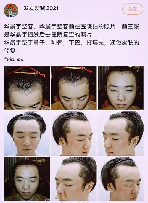 华晨宇被前任曝光整容,女方称张碧晨才是插足者,晒出一系列实锤