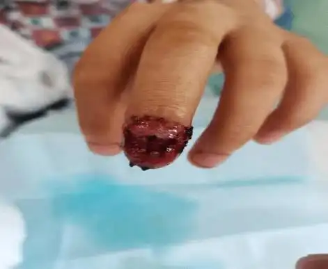 注意家长不留意孩子差点被截指