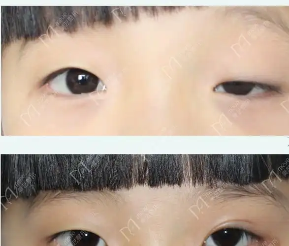 先天性眼睑下垂图片_眼睑下垂图片-rfid信息网