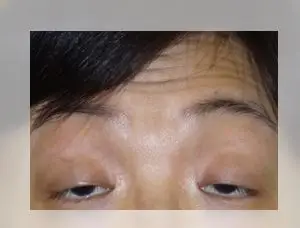 前额肌因眼皮下垂而提升